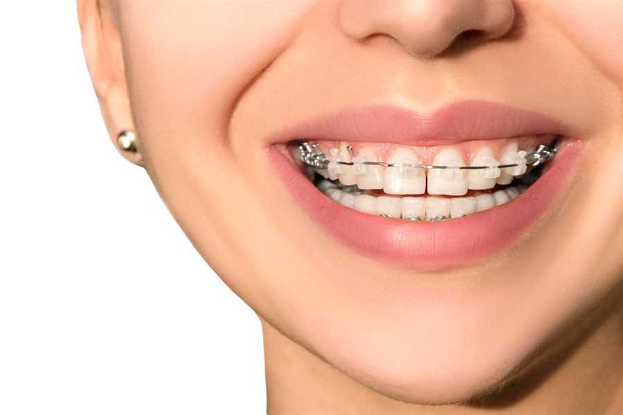 Tooth Gap Treatment