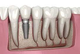Dental Implant